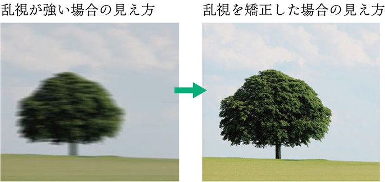 乱視矯正用眼内レンズについて | 診療トピックス | 高松市の眼科 ふくだ眼科クリニック